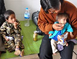 Hội chứng Seckel - Hình ảnh minh họa